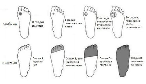 Диабетическая стопа