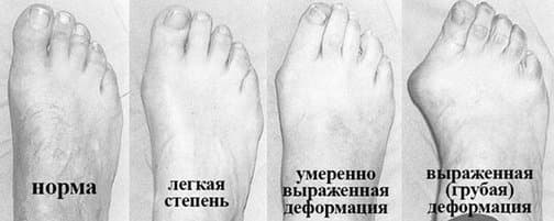 Вальгусная деформация стопы