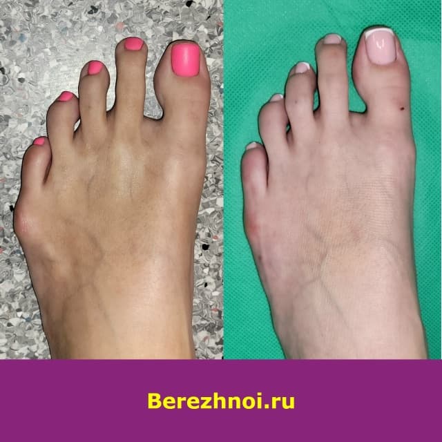 Стопа с шишкой на мизинце до и через 8 месяцев после чрескожной операции