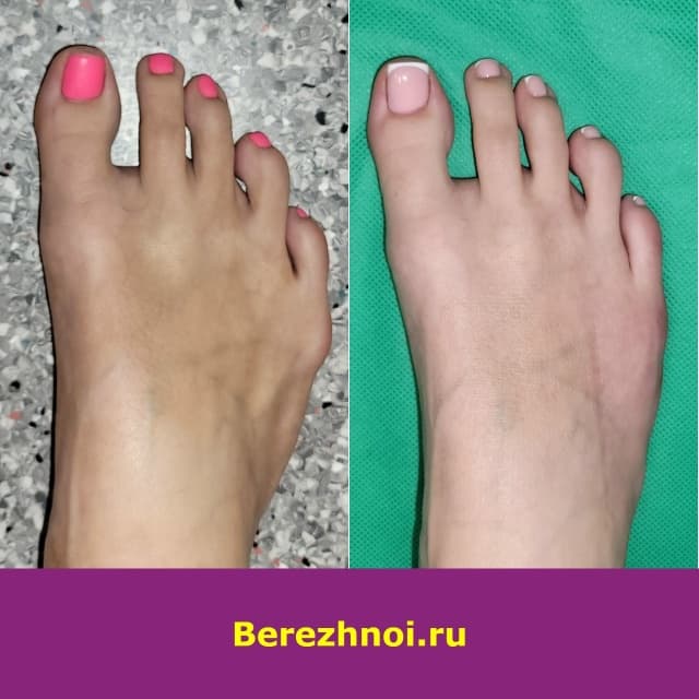 Шишка на мизинце до операции и та же стопа через 8 месяцев после чрескожной операции