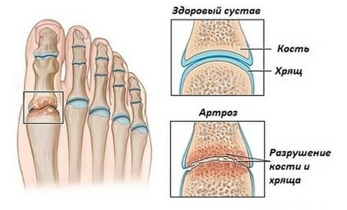Артроз сустава стопы